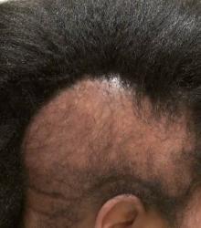 Black woman alopecia 